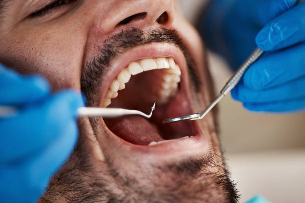 Best Dental Abscess Treatment in Port Dickinson, NY